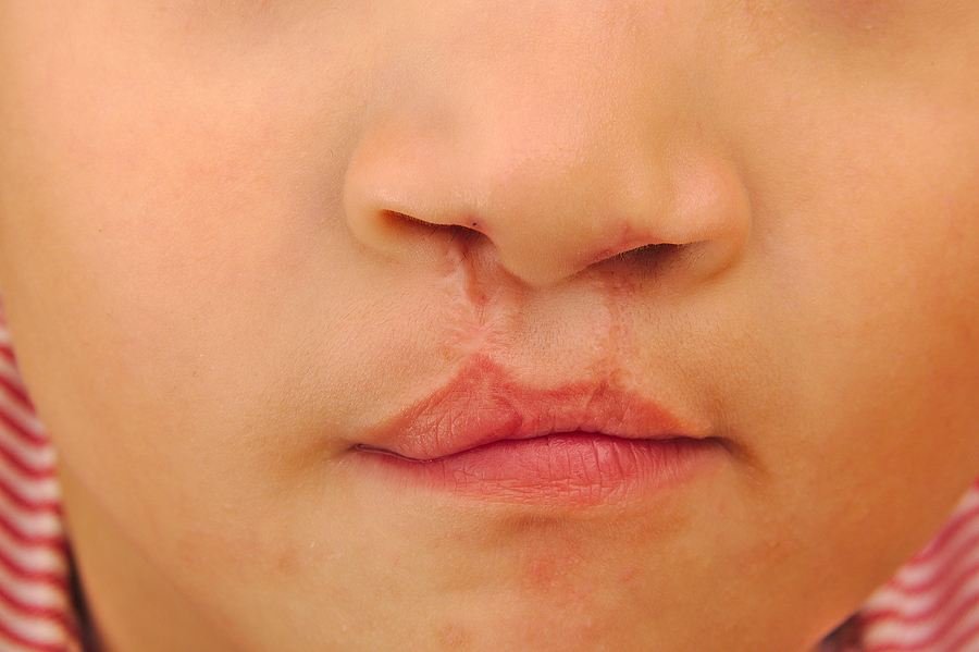 Mending Smiles: Exploring Cleft Palate Treatment Options