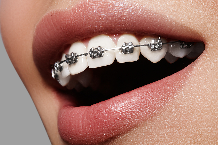 Achieve a Perfect Smile with Metal Braces in Lombard, IL