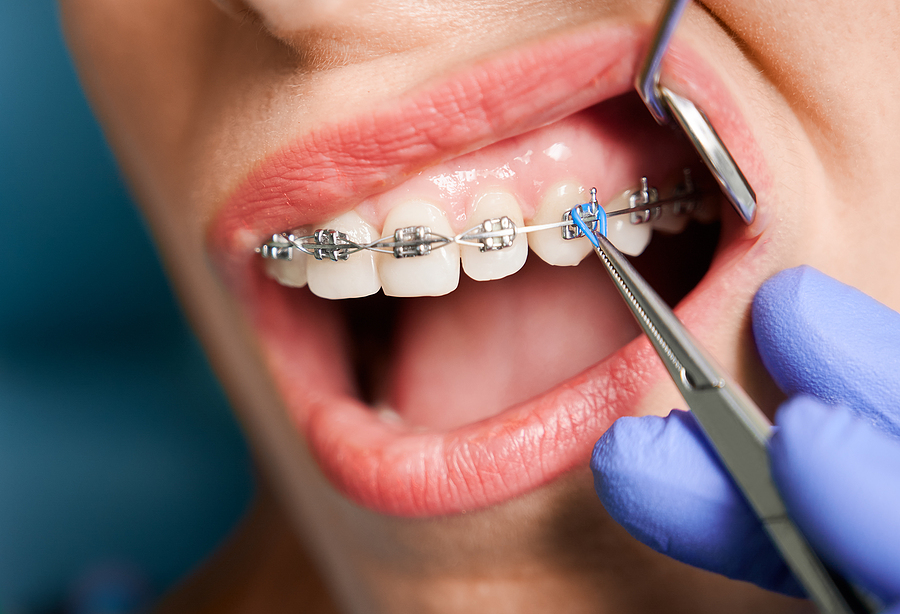 A Complete Guide to Metal Braces: Benefits, Process, and Care