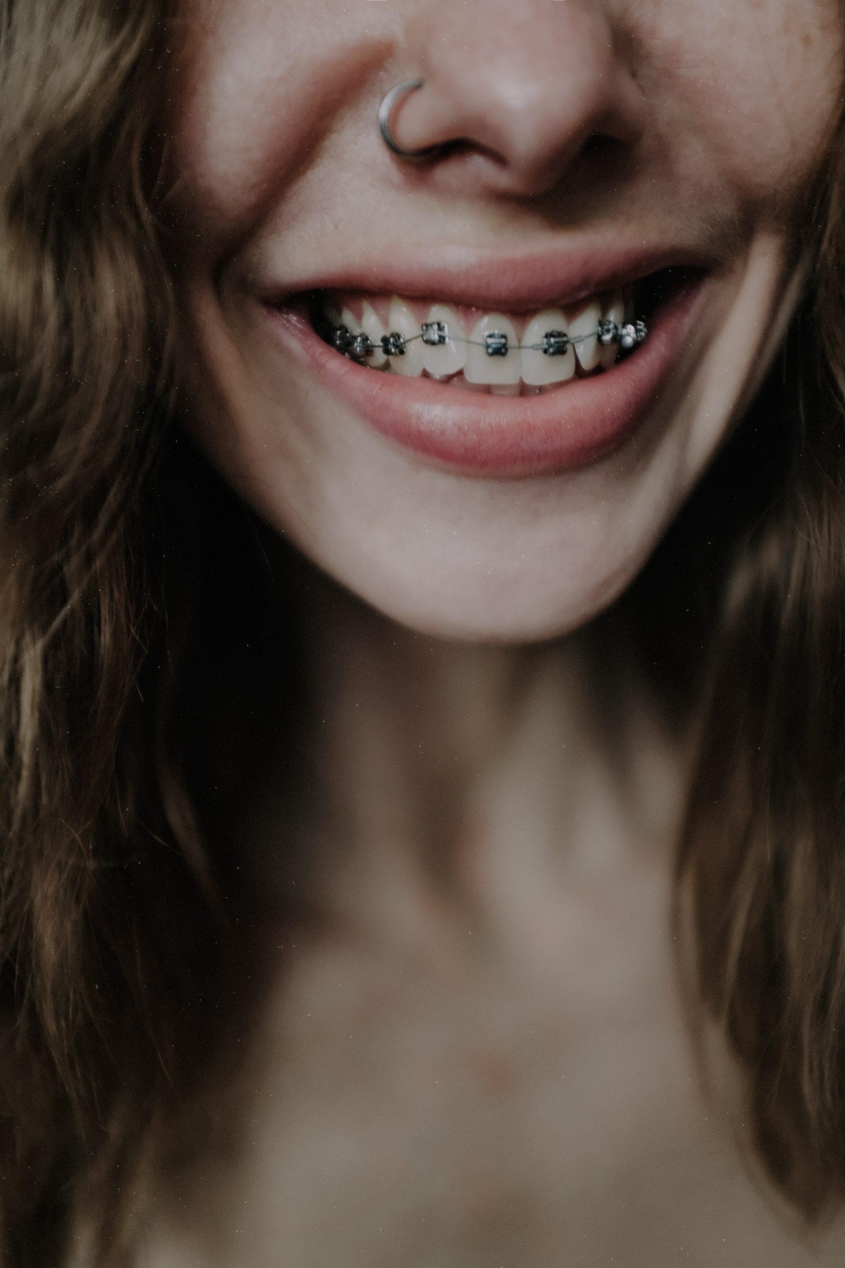 What Orthodontic Issues Can Metal Braces Fix?